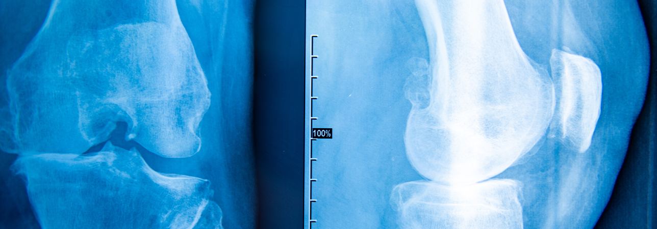 Treatment of cartilage damage in the knee